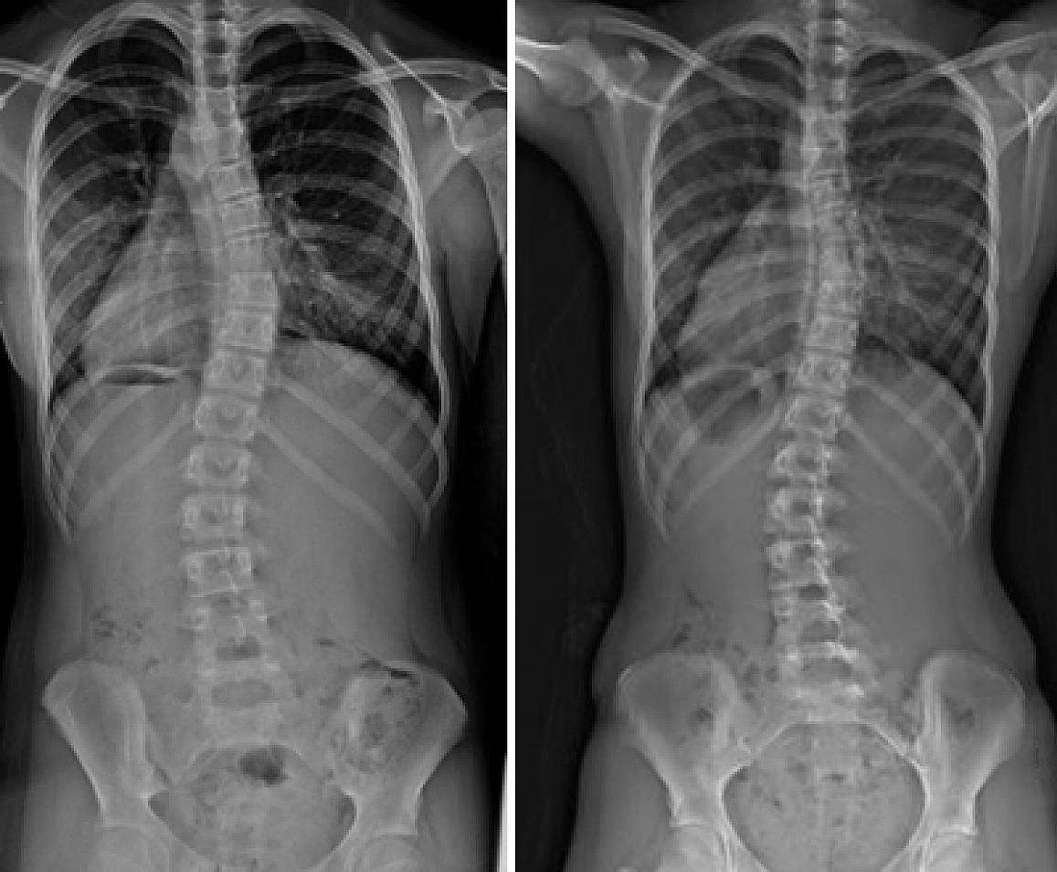 Before and after bracing x-rays of a girl with adolescent idiopathic scoliosis.