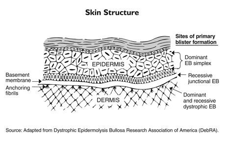 Epidermolysis bullosa occurs when genetic defects result in the skin’s two main layers not adhering properly at the dermal-epidermal junction.