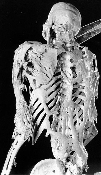 Photo of a skeleton of FOP patient.
