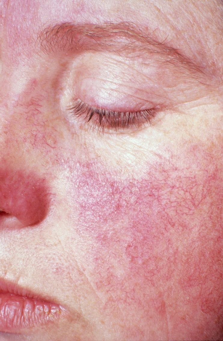 Photo of butterfly rash on the face.