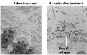 The image on the right shows the presence of type VII collagen in skin after gene therapy, compared to untreated skin on the left.
