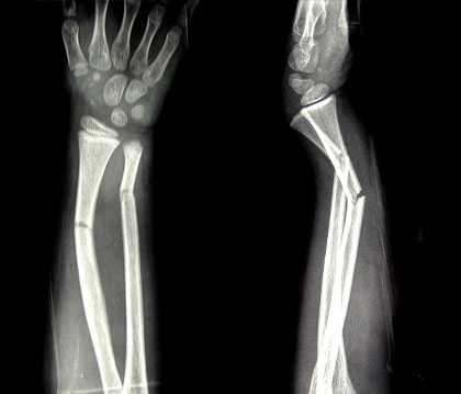 X-ray image of a child’s forearm fracture. Photo credit: eORIF LLC.