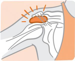 Illustration of a bursa in a shoulder joint