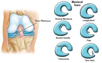 Anatomical illustration showing meniscus of knee