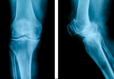 X-ray image of knee.