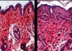 Two microscopic images of mouse skin one normal and one inflamed.