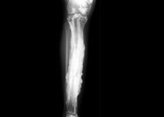 An x-ray image showing excess bone formation.