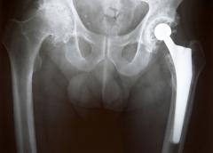X-ray of a hip replacement.