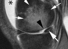 MRI image of a knee.