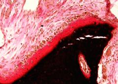 Microscope image of collagen (in red) that can't mineralize properly.