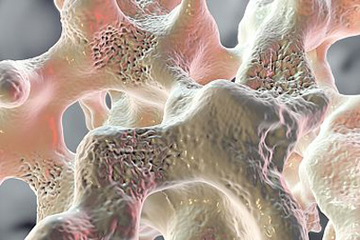 Bone tissue with osteoporosis has more voids than healthy bone