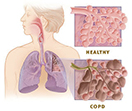 healthy vs copd organs in the body