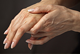 Hands with arthritis