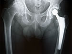 x-ray of hip replacement