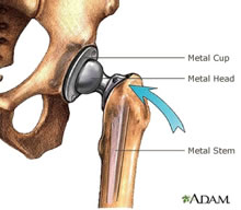 Metal-on-Metal Hip Implants